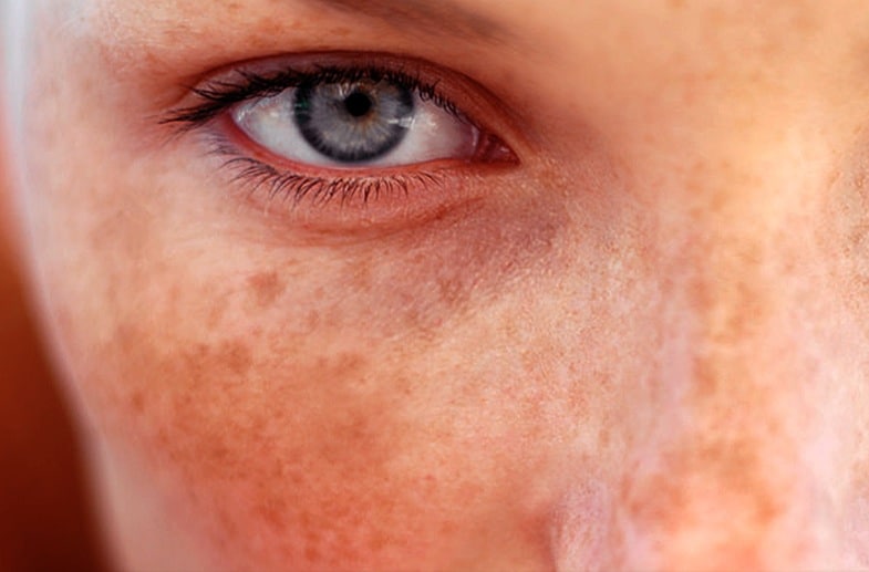Manchas na Pele: Atenção e Ação