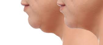 Adeus Papada: Pescoço Perfeito em Casa