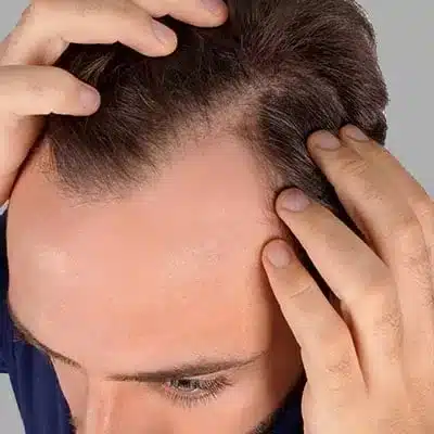 Ervas: Creme Natural para Calvície