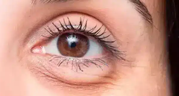 Acorde Renovado: Elimine Bolsas Oculares