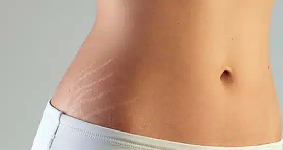 Segredos Naturais Contra Estrias