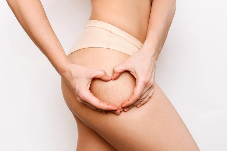 Segredos Naturais Contra Estrias